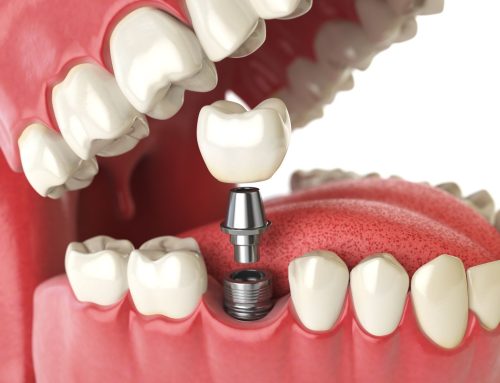 Dental Implants vs Dentures: Which Is the Better Option?